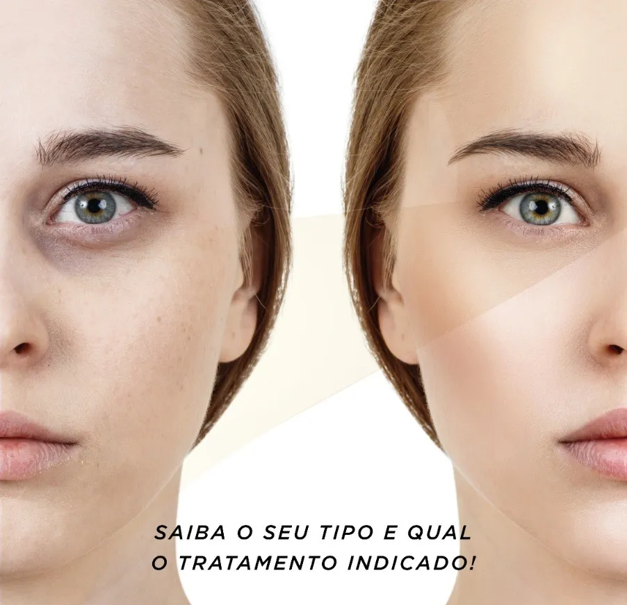 Como se Livrar das Olheiras Permanentemente