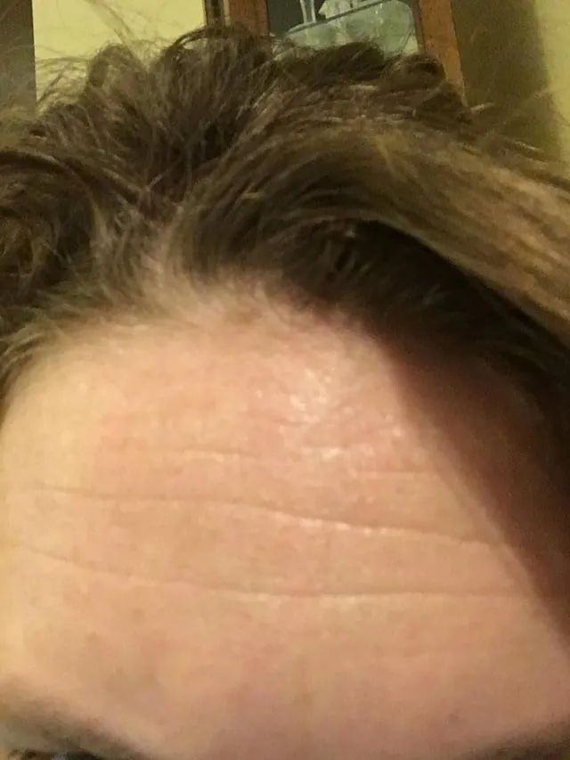 Como Posso Me Livrar das Rugas na Testa?