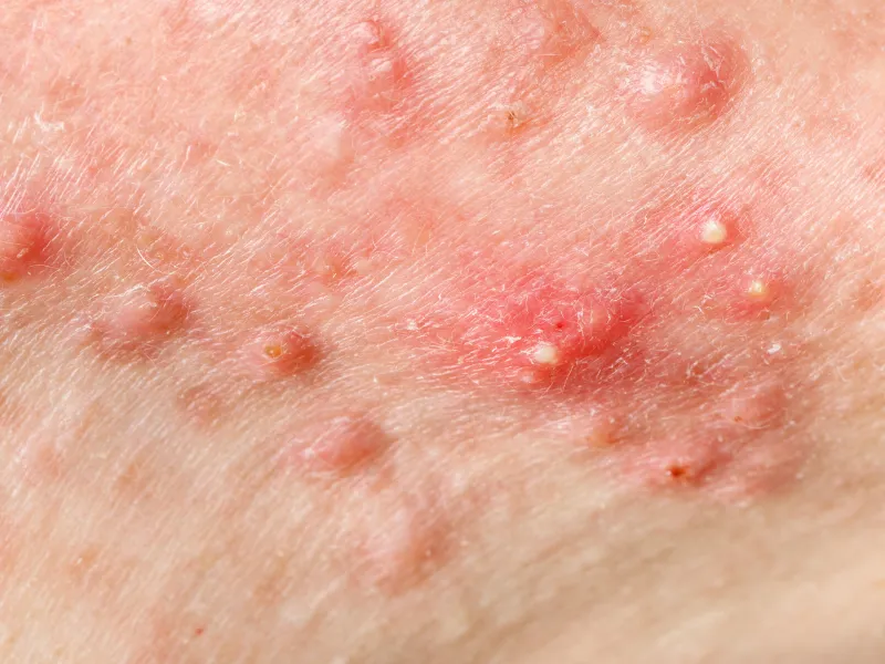 Acne Hormonal: Como Lidar com Esse Problema em Qualquer Idade