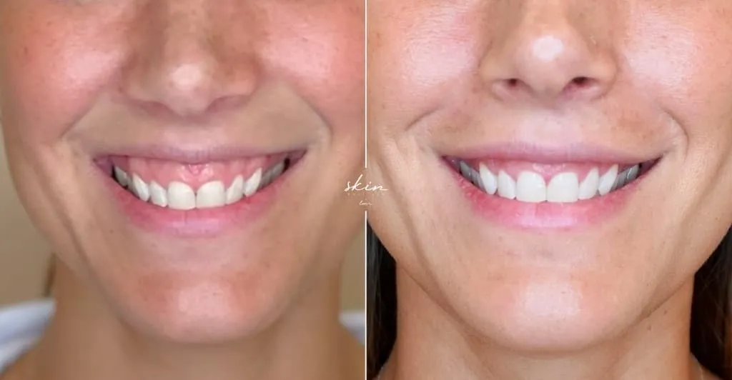 Tudo Sobre Botox para Linhas de Sorriso